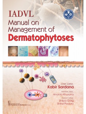 IADVL Manual on Management of Dermatophytoses