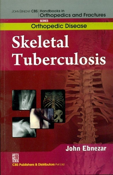 Skeletal Tuberculosis (Handbooks In Orthopedics And Fractures Series, Vol.33: Orthopedic Diseases)