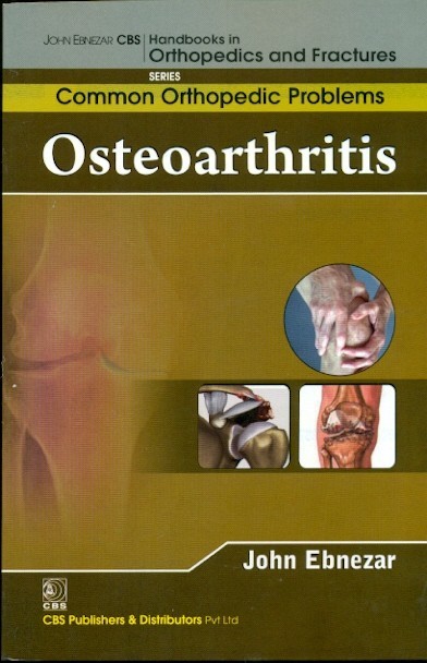 Osteoarthritis  (Handbooks In Orthopedics And Fractures Series, Vol. 87 -Common Orthopedic Problems)