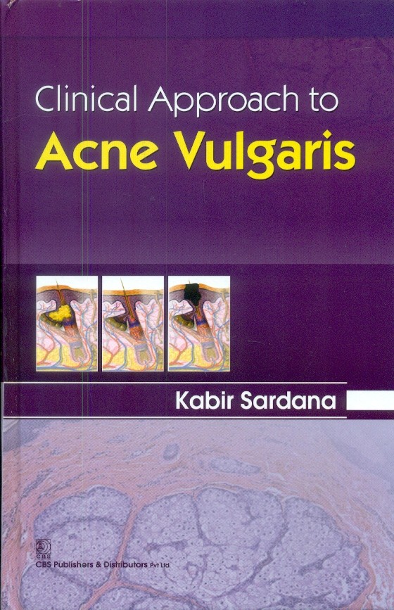 Clinical Approach To Acne Vulgaris