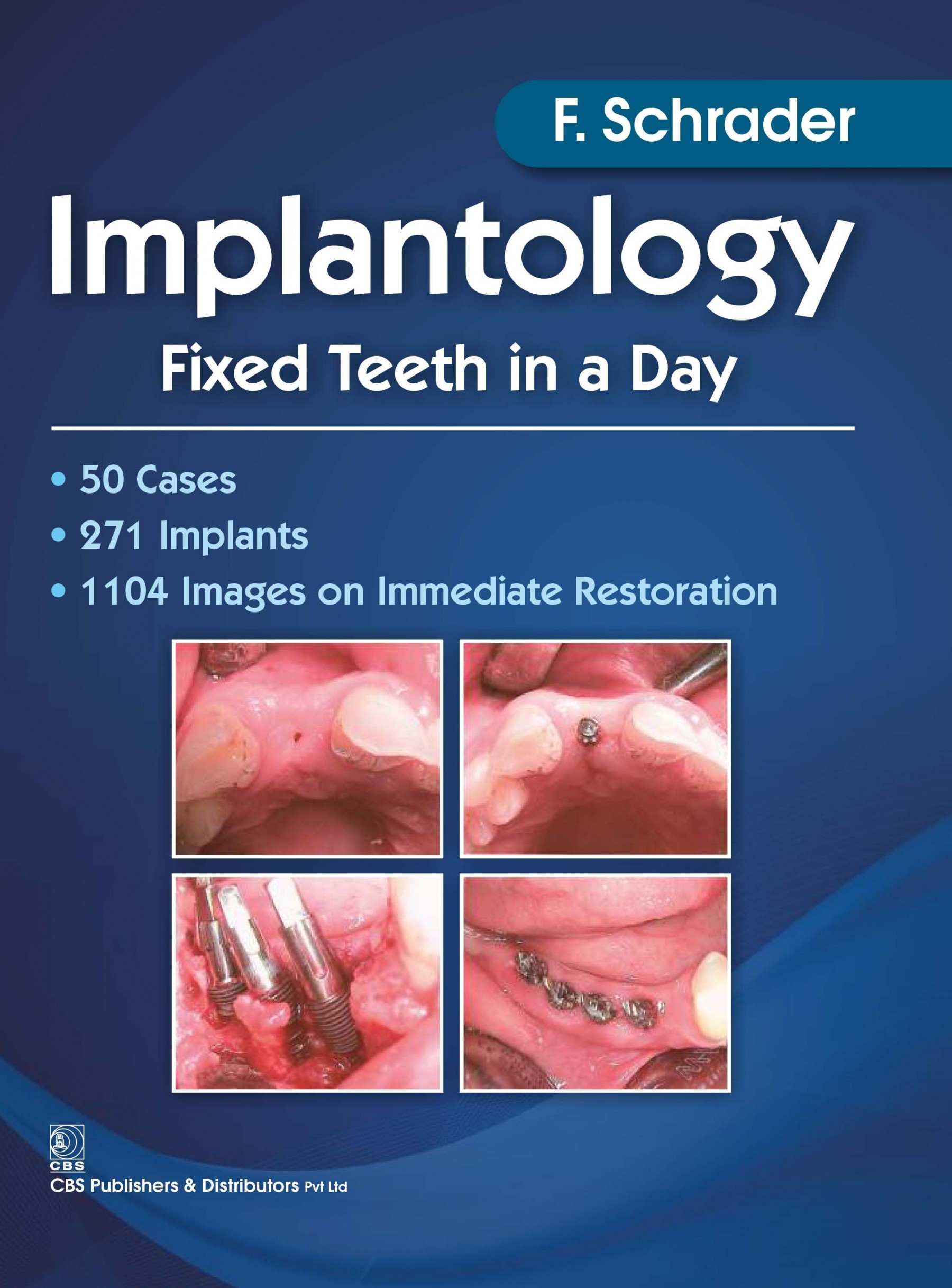 Implantology Fixed Teeth In A Day (Pb 2017)