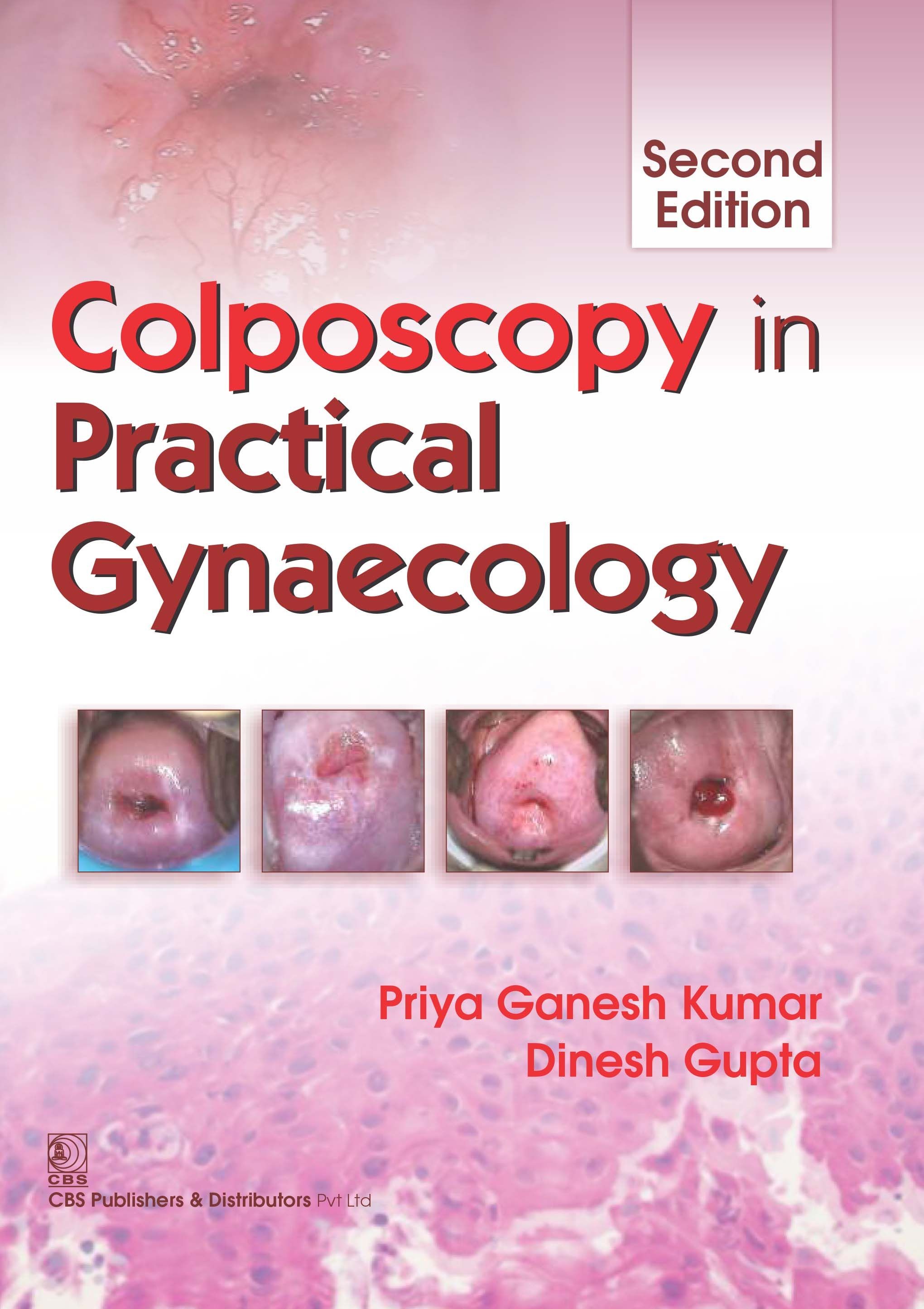 Colposcopy In Practical Gynecology 2Ed (Pb 2017)