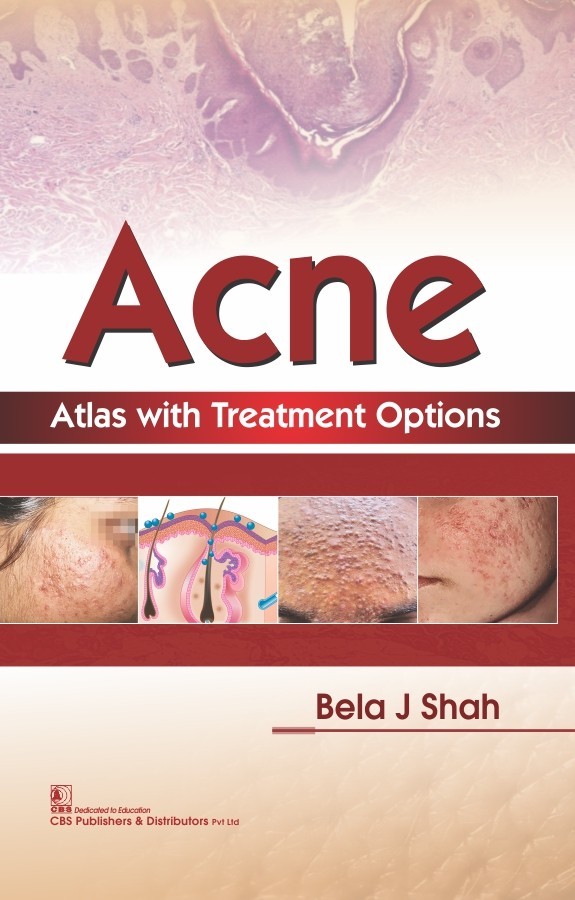 Acne Atlas with Treatment Options Atlas with Treatment Options