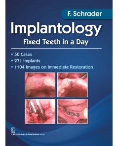 Implantology Fixed Teeth In A Day (Pb 2017)