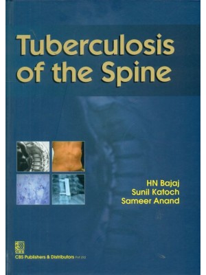 Tuberculosis Of The Spine (Hb 2014)