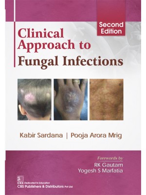 Clinical Approach to Fungal Infections
