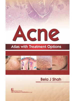 Acne Atlas with Treatment Options Atlas with Treatment Options