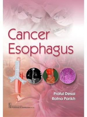 Cancer Esophagus